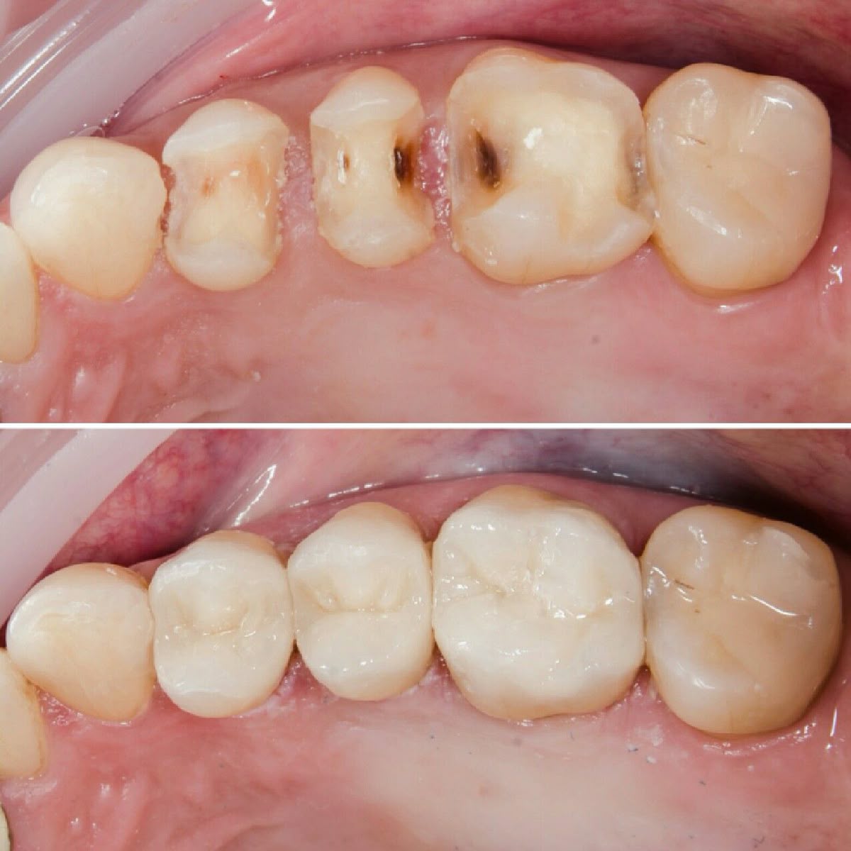 Điều trị răng sâu